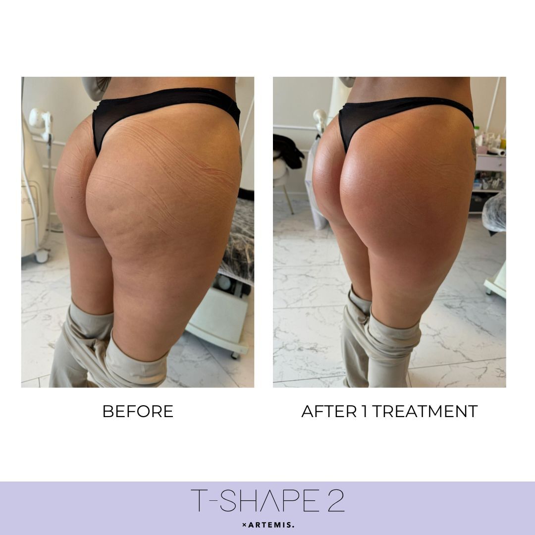 Before and after one T-Shape 2 treatment showing glute contour improvement.