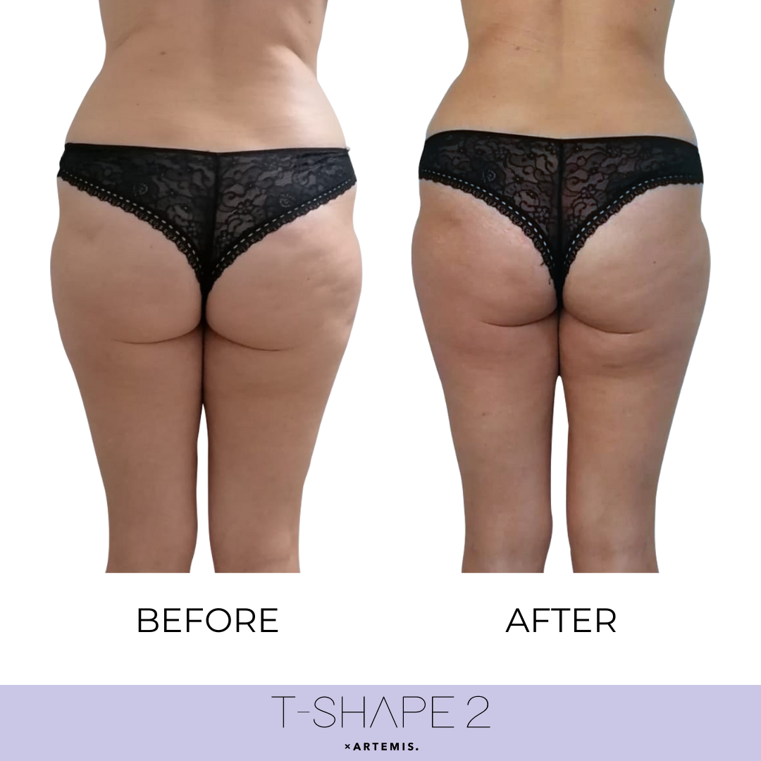 Before and after glute and thigh comparison showing a smoother silhouette.