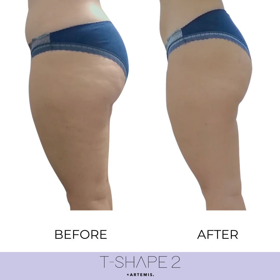 Before and after thigh contouring comparison from T-Shape 2 treatment.
